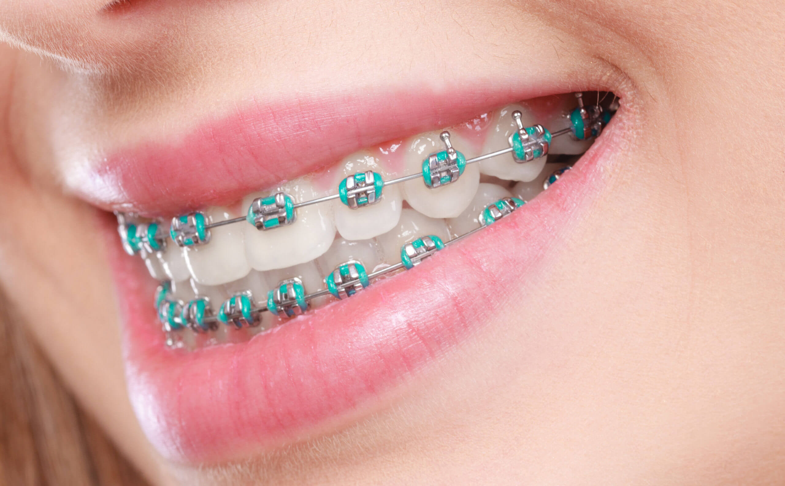 close up of a smile showing metal braces with teal elastic bands on the teeth and gums visible at the lips' edge.