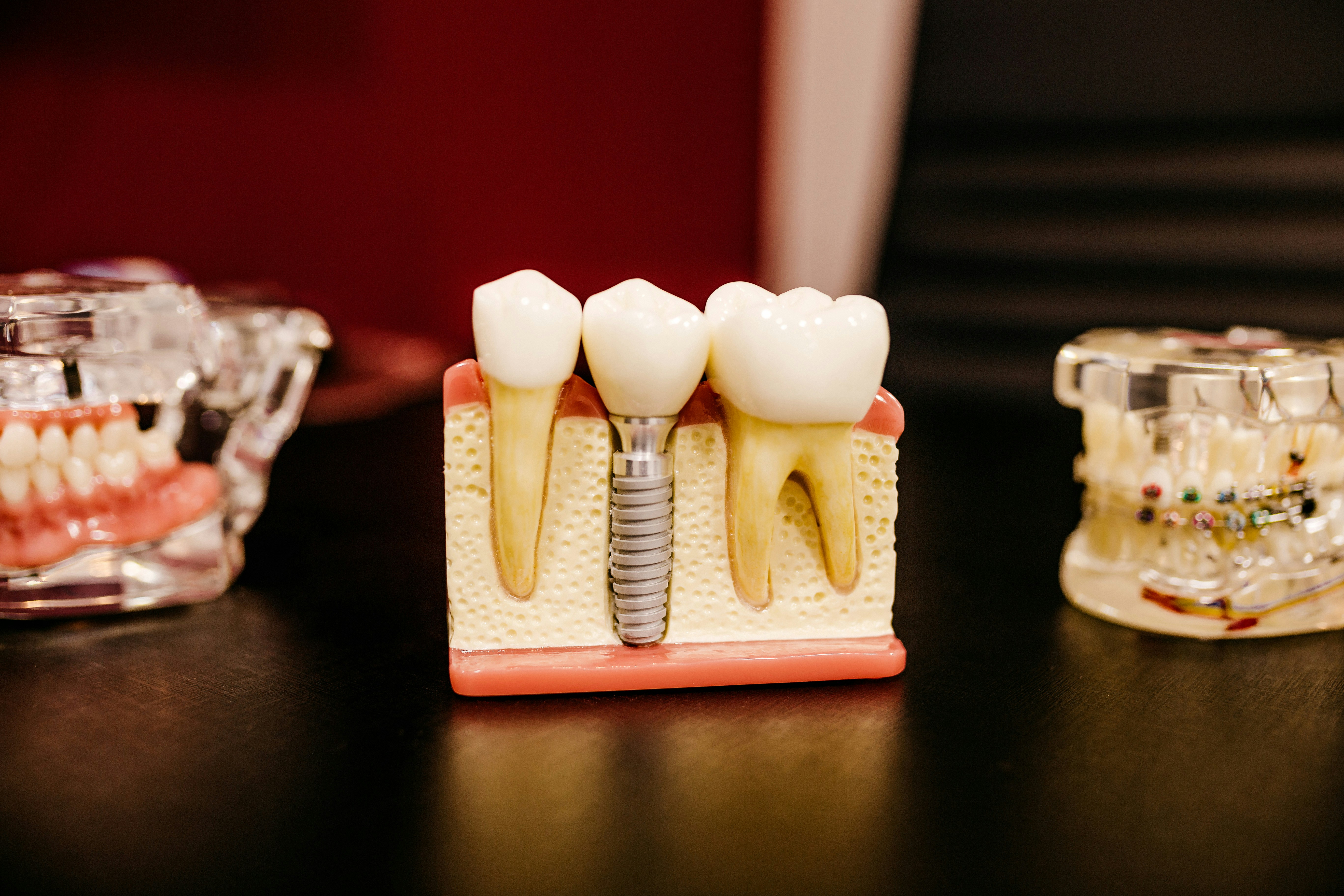 How Implant Dentists Build Confidence Through Lasting Restorations
